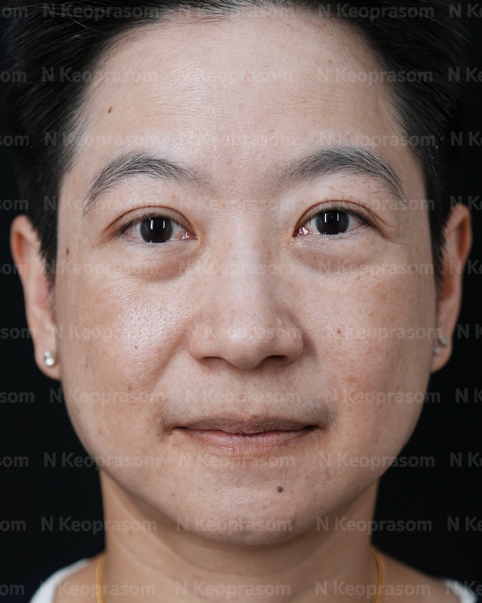 คุณนก after