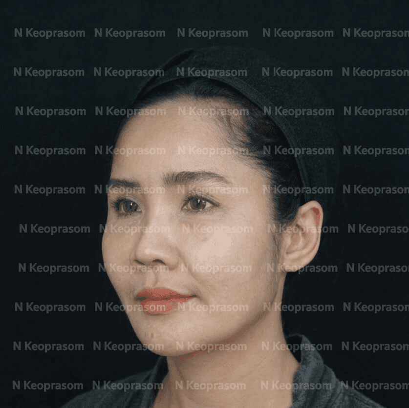 After treatment result