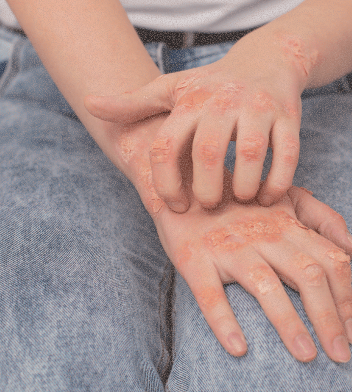 Psoriasis skin condition
