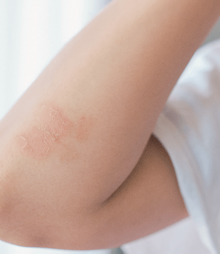Psoriasis on hands