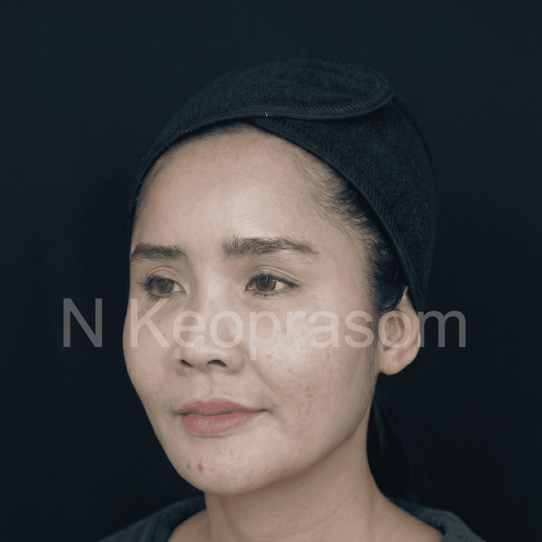 Before treatment result